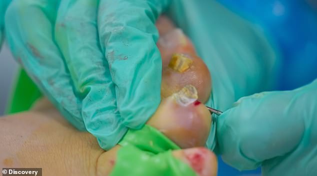 The stomach-churning images Craig is given fourteen anesthetic injections in his toes and seven toenails are removed