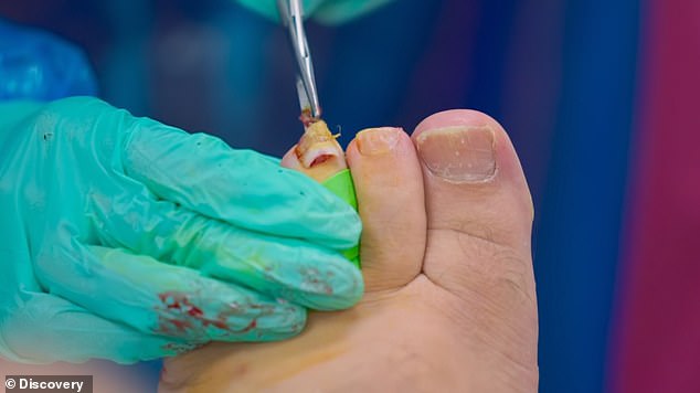 When Marion started the treatment, she took out the needle to numb Craig's toes before removing the toenails from the nail bed.