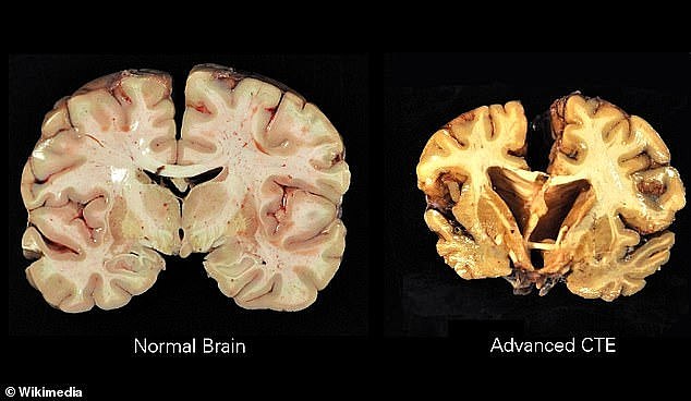 A brain with advanced CTE (photo right) appears shriveled.  As tau proteins build up and brain cells die, the brain's volume decreases and shrinks