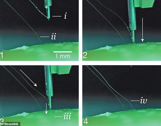 In the operation, a 'sewing robot' removes a small piece of the skull, connects the thread-like electrodes to certain parts of the brain, sutures the hole closed and all that is visible is a scar left from the incision