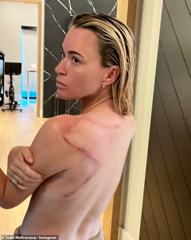 Teddi urged her fans to get their skin checked so they can avoid the type of surgery she had