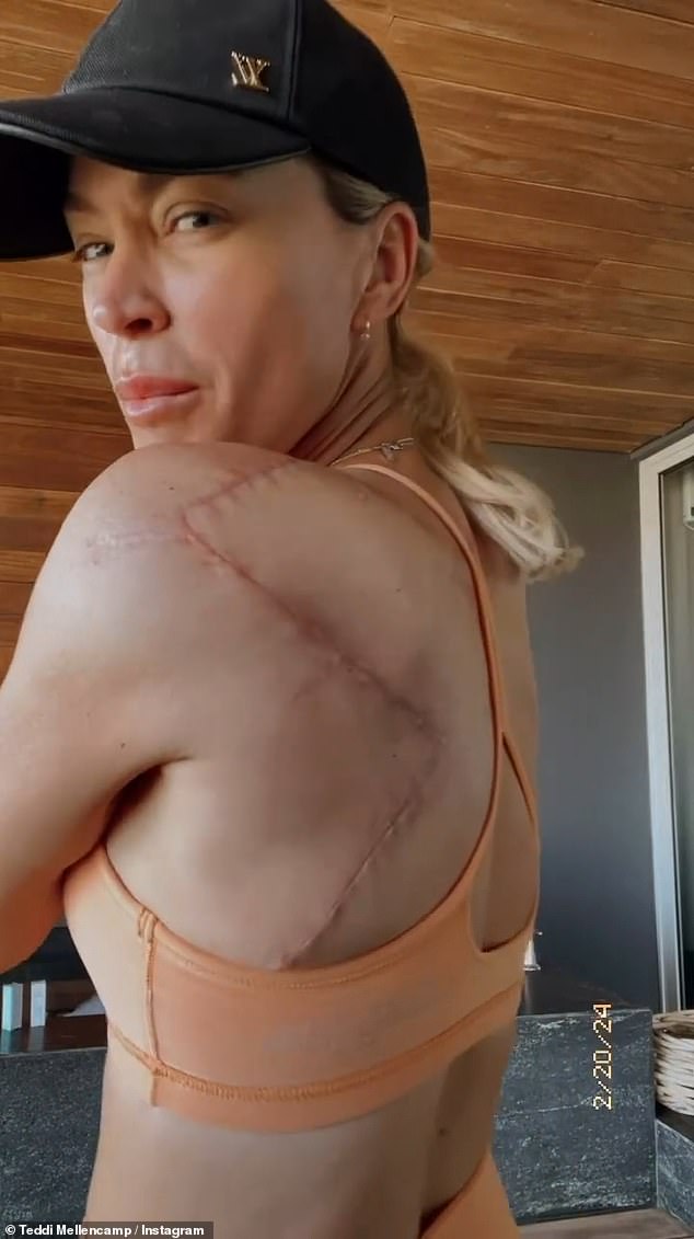 The 42-year-old 'Real Housewives of Beverly Hills' star revealed last October that she had been diagnosed with stage 2 of the disease and underwent surgery in December to remove melanoma from her back.  But now she has revealed her team after doing another investigation.  suspicious mark on her arm