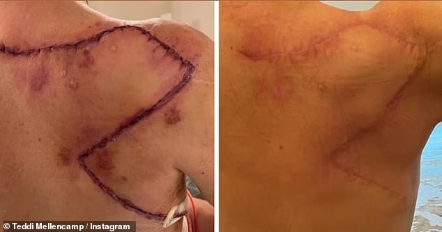 In a post on Instagram, she shared an update on her surgery scar and shared news about her three-month check-up