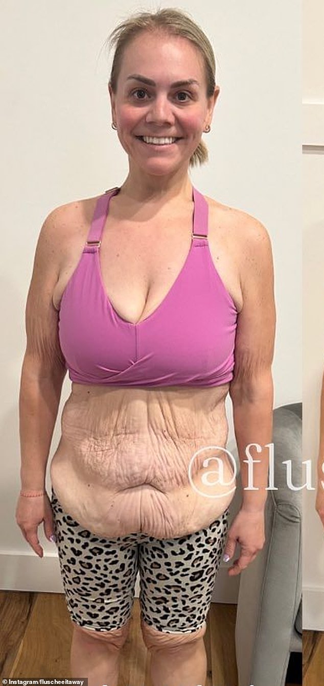 She lost 270 pounds and has opened up the reality of dealing with loose skin after undergoing four surgeries (seen after her first) to get rid of the sagging flaps across her body