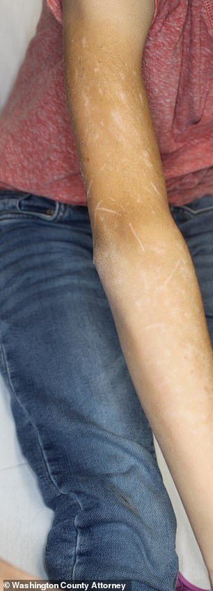 The young girl with scratches on her arm