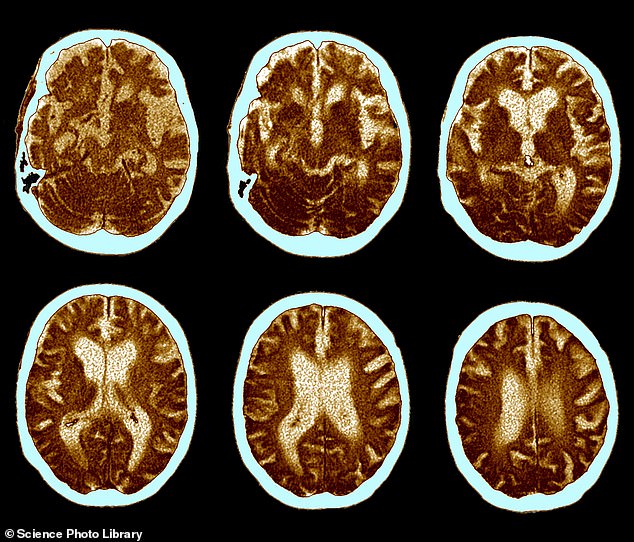 MRIs performed over the past 100 years have shown that brain size has increased by 6.6 percent and could reduce the risk of developing Alzheimer's disease for younger generations