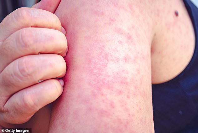 Measles usually starts with cold symptoms before causing a rash consisting of small red spots, some of which may feel slightly swollen.  According to the NHS, it usually starts on the face and behind the ears before spreading further