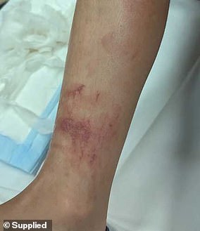 The skin turns red (photo) and starts to itch and burn