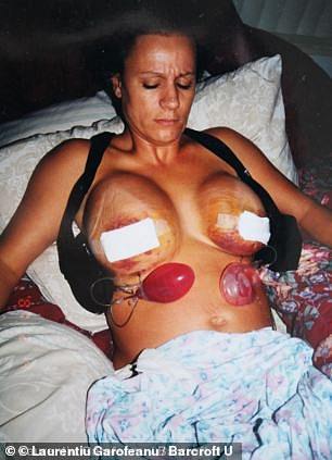 Mrs Wildd after surgery with breast size 800CC in 2001