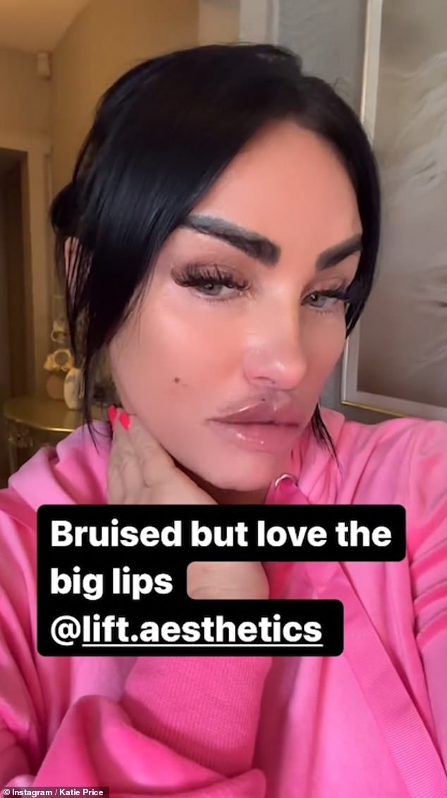 The internet personality revealed the results of another round of lip fillers on her Instagram Stories, after heading to the beauty salon for the fourth time in five weeks