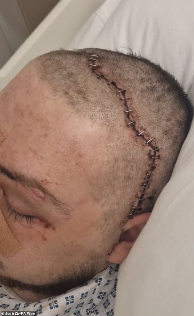 Mr Ziv underwent a 12-hour operation to have titanium plates placed in his face and skull to reconstruct them - leaving him with a huge scar from ear to ear