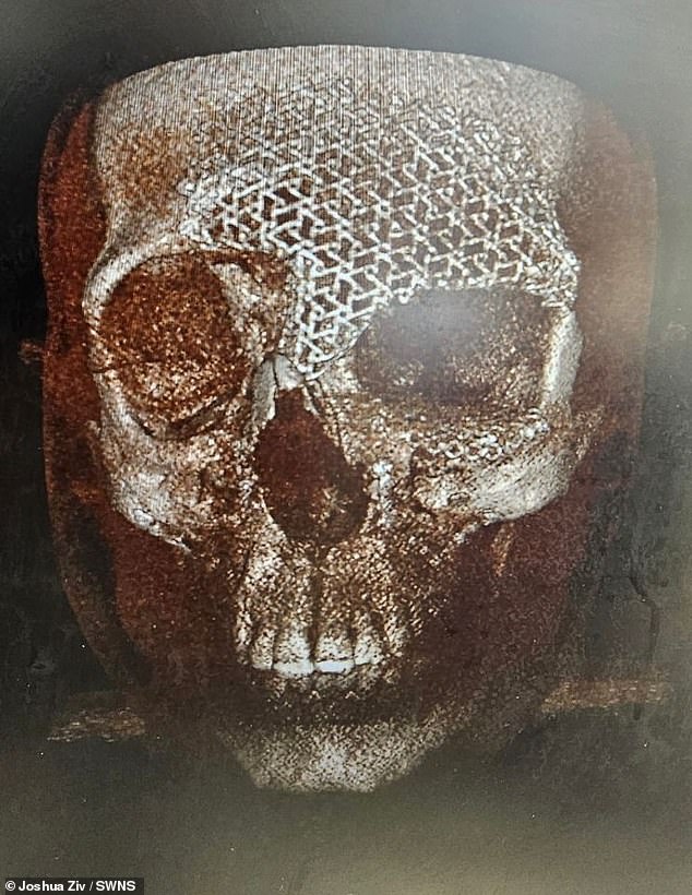 An x-ray of Mr. Ziv's face.  Once he was taken to a hospital in Turin, it was found that Mr Ziv had broken almost every bone in his face except his jaw.