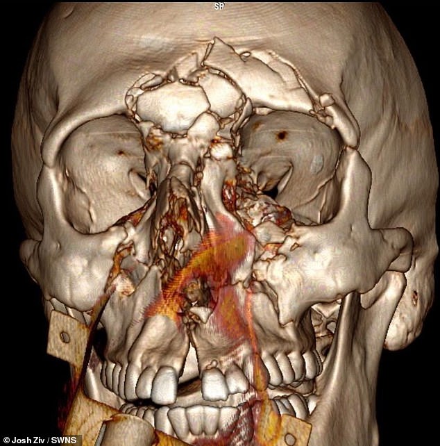 A 3D model of the damage to Mr. Ziv's face.  Mr Ziv said: 'For about two to three weeks after the operation there was movement in my face, but limited