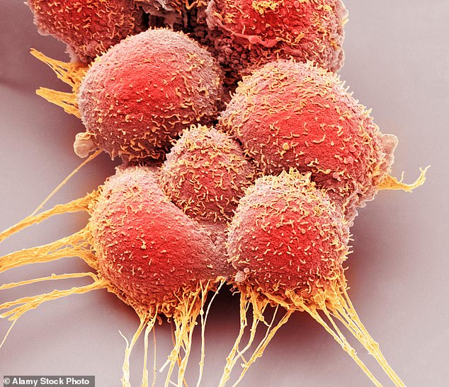 Prostate cancer claims 12,000 lives a year, making it the second biggest cancer killer in men in Britain (stock image of prostate cancer cells)