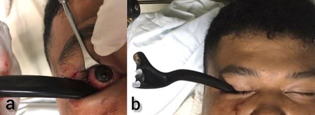Stomach-churning footage shows the handle embedded in the unidentified 19-year-old's right eye socket.  The fire brigade probably had to cut the brake lever from the bicycle at the scene of the accident