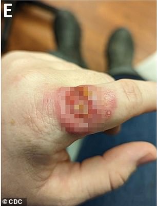 The infection caused horrific sores on the vet's finger and spread up her arm