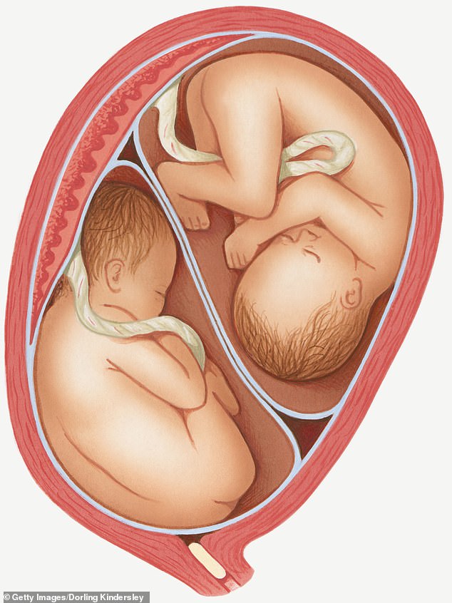 In the womb, the male sex hormone, testosterone, has been shown to sometimes affect female twins