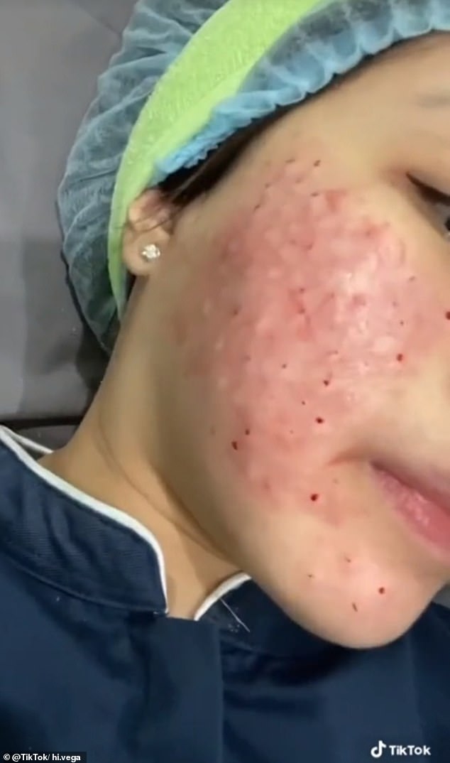 Another TikTok video posted by @hi.vega, who has more than 4,800 followers, shows her getting the shots at a clinic.  After the treatment, her face is lumpy and covered in blood