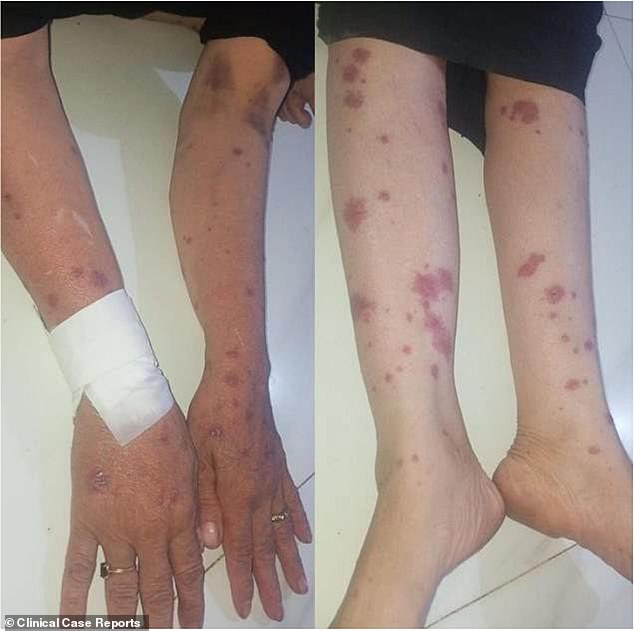 Rashes also developed over the patient's extremities, as shown above.  Tests showed that the outer layer of her skin, which contains billions of healthy cells, had also become loose