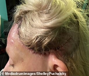 After stumbling while running, Ms Puchalsky drove herself to the nearest hospital with blood streaming down her face and required more than 40 stitches.