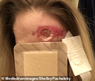 After a follow-up procedure, her skin began to peel so much that it left a three-millimeter hole in her skull, almost exposing the bone.