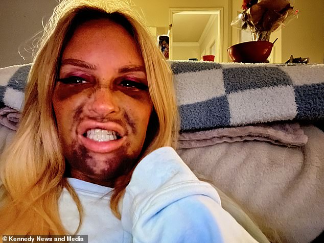 Although she had been warned by doctors about bruising, the stay-at-home mum admitted she didn't expect the pain to be so 'brutal', nor that the bruising would be so severe.