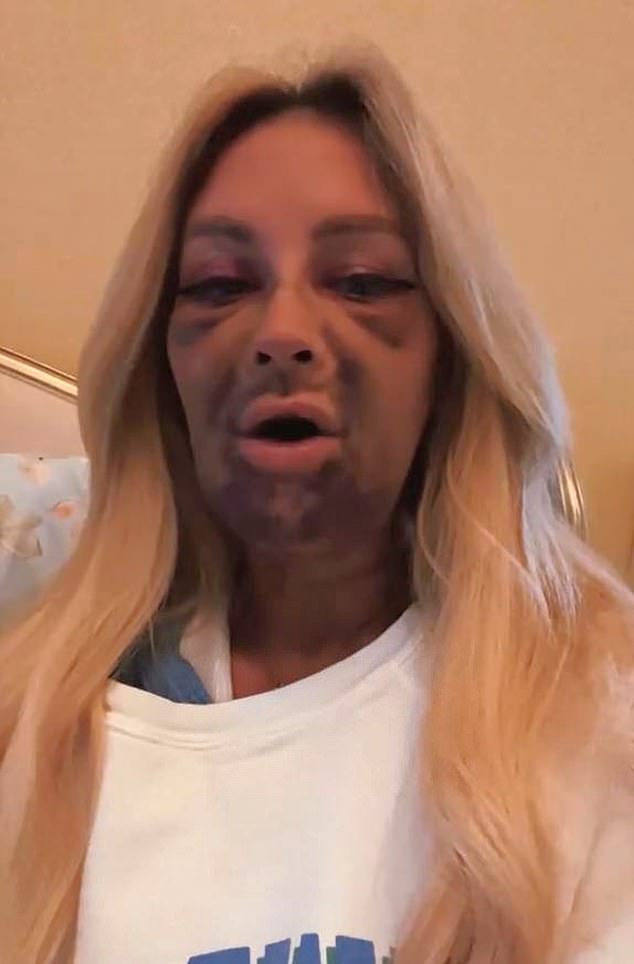 The 'horrific' deep purple bruises started at her neck and chin and spread across her face, getting worse hour by hour, even reaching under her eyes