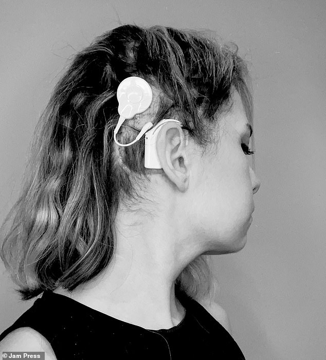 During her ear tumor removal surgery, Scaglione had an auditory brainstem implant installed.  Although she does not understand or hear the language through the implant, she hears buzzing that allows her to signal specific things