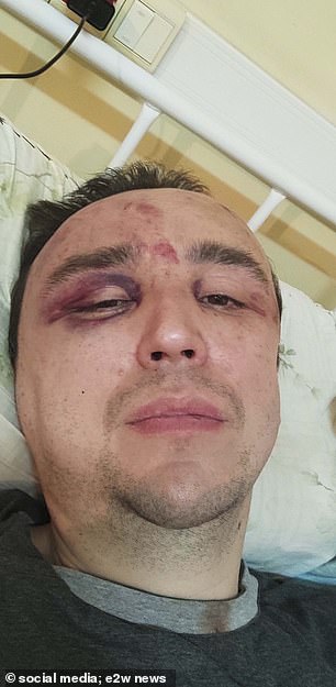 He was beaten causing a broken eye socket and ribs as well as a broken nose