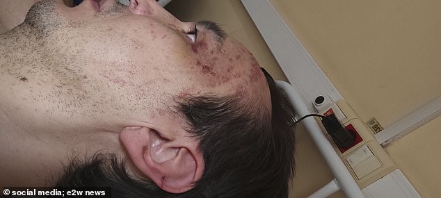 During the treatment, injuries can be seen on Khammatov's forehead and ear