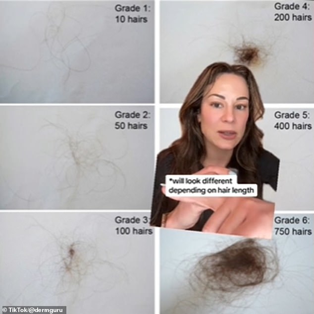 In this clip, Dr.  Zubritsky created a numbered chart showing the hair loss scale and what it actually looks like