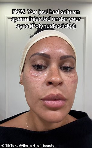 An aesthetic nurse @the_art_of_beauty from Surrey, who has just over 1,000 followers, also posted a video of her face moments after receiving the treatment under her eyes