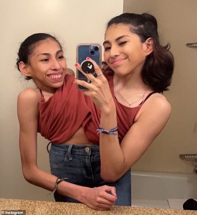 Conjoined twins Carmen (right) and Lupita Andrade, 23, are as close as two sisters can be – and now share their honest answers to frequently asked questions about their lives