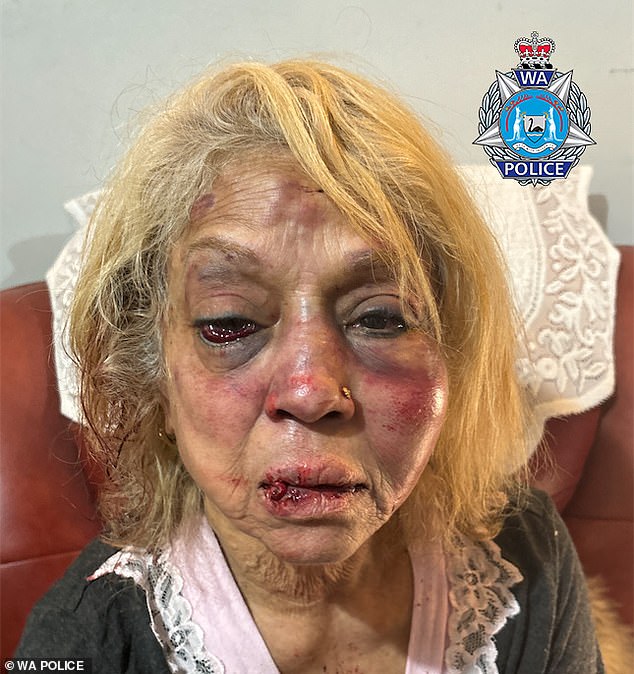 Officers released a gruesome photo of the woman's injuries - with her permission - to illustrate the attackers' brutality