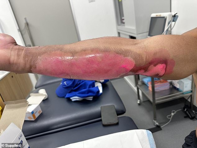 Canberra Raiders star Albert Hopoate has shared the extent of burns to his arm from the freak accident involving a barbecue and olive oil bottle that caught fire