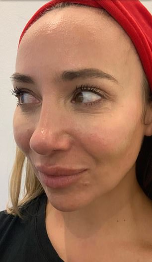 Dr.  Leonard pictured before polynucleotide treatment.  The 40-year-old says she got the treatment to improve the appearance of eczema and dry skin around her eyes