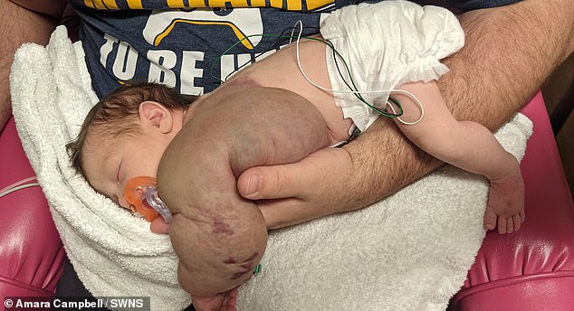 Jessi Campbell was born on August 28, 2021 with a lymphatic malformation that caused a one-kilogram mass to develop on the left side of her body