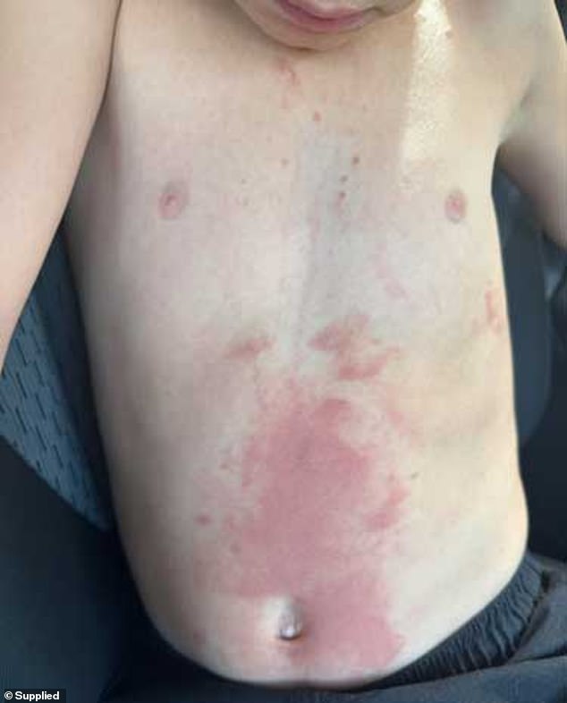 After a terrifying experience, a Sydney mother has warned all parents about the unexpected dangers of a food item commonly found in Australian homes.  The rash it caused on Max's stomach is pictured