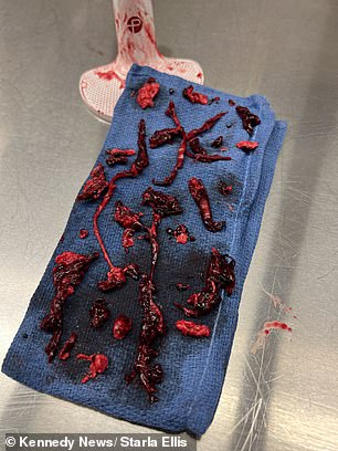 The 20 red blood clots were found on a piece of cloth after being removed from Ms Ellis' right leg