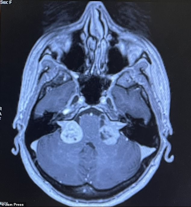 The rare condition, also known as NF2-SWN, causes non-cancerous tumors to grow along the nervous system.  During an MRI for a dancer's injury when she was a teenager, doctors diagnosed her