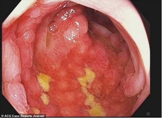 In this image of the patient's colon, the researchers pointed to inflammation and tissue damage due to ischemic colitis