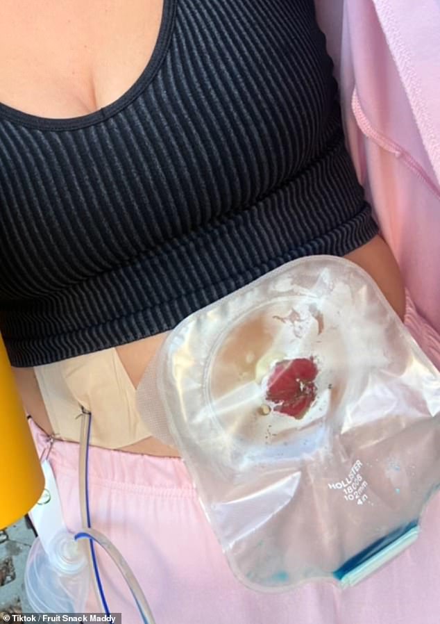 According to the American Cancer Society, a colostomy is an opening made in the abdominal wall of the abdomen during surgery.  A colostomy changes the way your body passes stool (Madison's colostomy bag pictured)