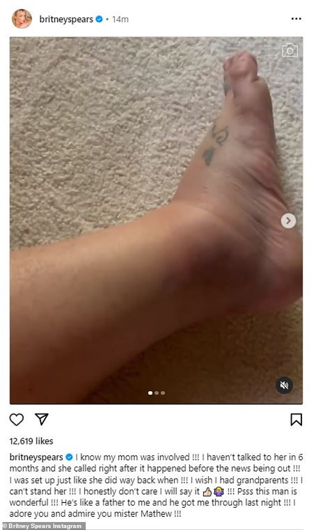 The superstar, 42, backed up the claim that she twisted her ankle by posting two videos on Instagram showing the swollen, bruised injury on her right foot.