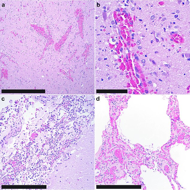 Scientists found (a) brain hemorrhages, (b) dead neurons and glial cells in the brain, (c) hemorrhages in the lining of the brain and spinal cord, and (d) minimal changes in lung tissue.