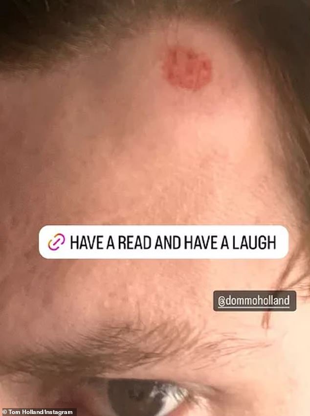 On Sunday, he shared an Instagram story showing a red bruise at the top of his forehead, which he sustained during a round of golf in Scotland late last month.