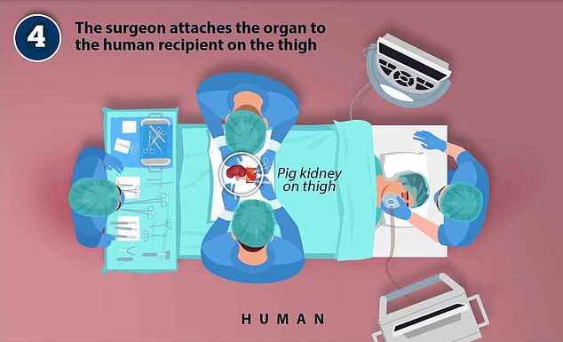 The doctors make an incision in the thigh bone and use instruments to dig a tunnel to the area where the kidney is located.