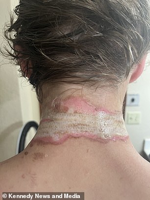 The teenager suffered second, third and fourth degree burns and will now be scarred for life