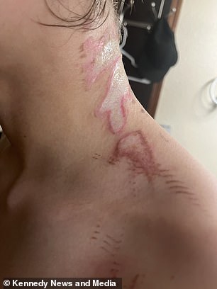 The teenager suffered second, third and fourth degree burns and will now be scarred for life