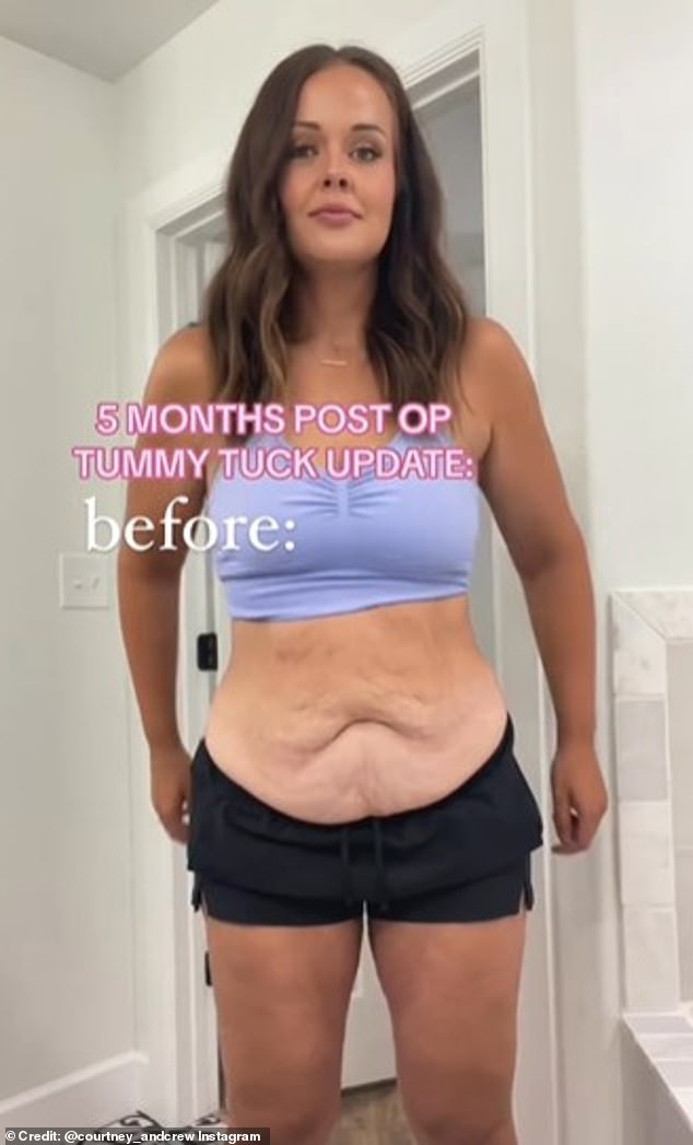 In June 2023, when she came off the injections, she had almost 2.7kg of excess skin on her stomach, which she described as a 'bag'.