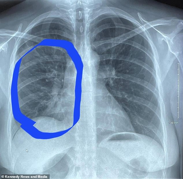 Doctors told her: 'It looks like a tree with branches, it's called 'tree knotting' and it's actually the deterioration of your lungs'